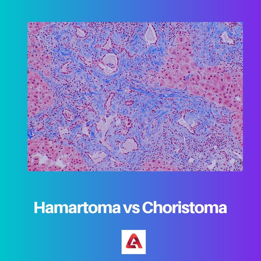 Hamartoma versus Choristoma