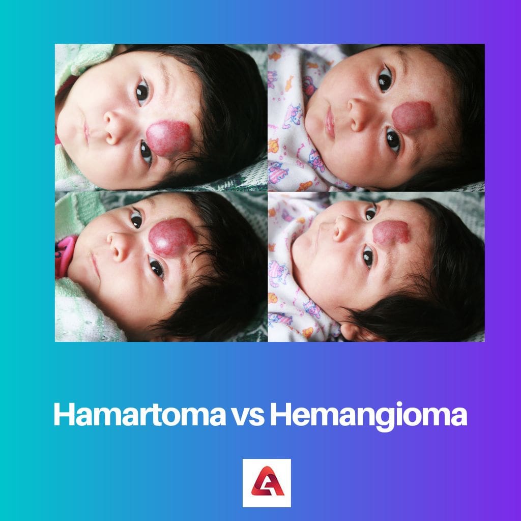Hamartoma vs Hemangioma