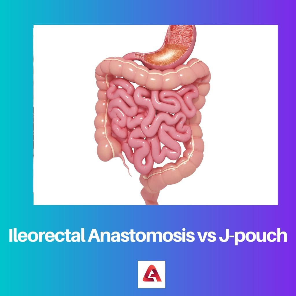 Ileorectal Anastomosis vs J pouch