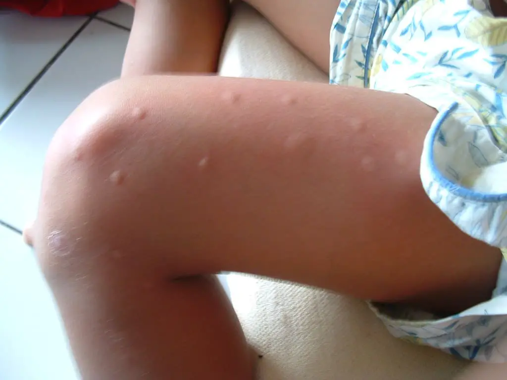 mosquito bite 1